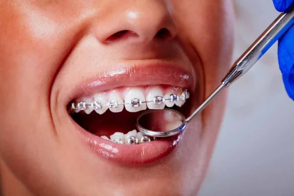 How much are braces in Toronto?