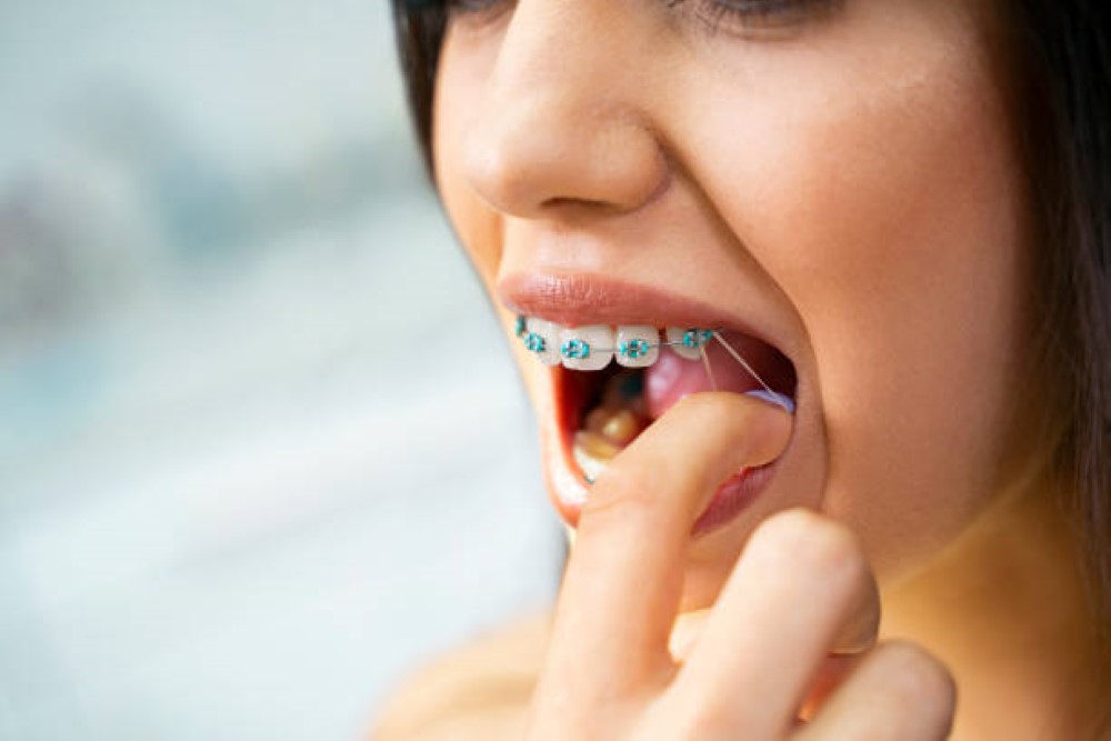 How much are braces in Toronto?
